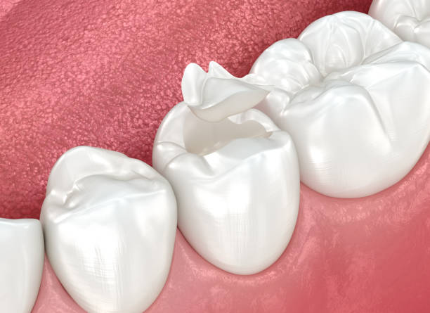 Best Dental Fillings (Composite and Amalgam)  in Cozad, NE